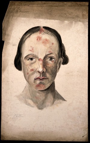 view Head of a woman with a disease affecting her face. Watercolour by Christopher D' Alton.
