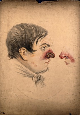 Head of a man seen in profile with a severe disease affecting his nose; and a detail of the nose as seen from the other side. Watercolour by Christopher D' Alton, 1860.