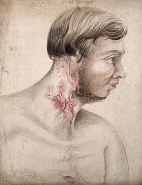 Head and chest of a man with a disease affecting his neck, seen in profile. Watercolour by Christopher D' Alton, 1856.