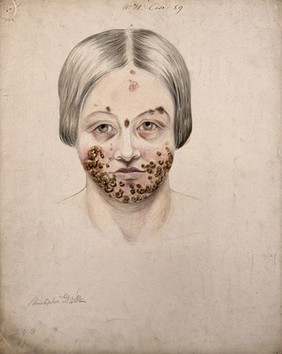 Head of a woman with a severe disease affecting her face. Watercolour by Christopher D' Alton, 1856.