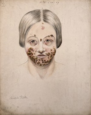 view Head of a woman with a severe disease affecting her face. Watercolour by Christopher D' Alton, 1856.