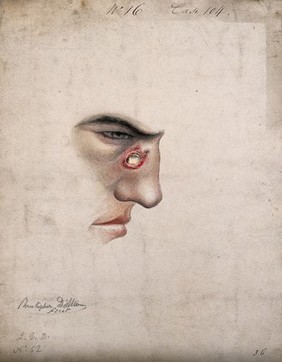 A detail of a man's face seen in profile with a severe disease affecting his nose. Watercolour by Christopher D' Alton, 1856.