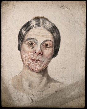 Head of a woman with a severe disease affecting her face. Watercolour by Christopher D' Alton.