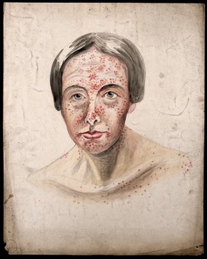 view Head of a woman with a severe disease affecting her face and shoulders. Watercolour by Christopher D' Alton.