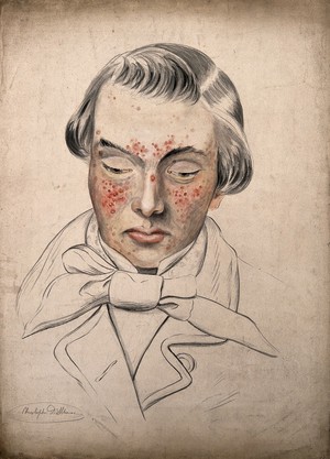 view Head of a man with a severe disease affecting his face. Watercolour by Christopher D' Alton, 1858.