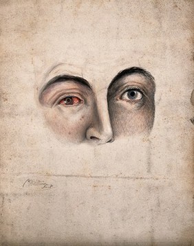 A section of a face (eyes and nose) with a disease affecting one eye. Watercolour by Christopher D' Alton.