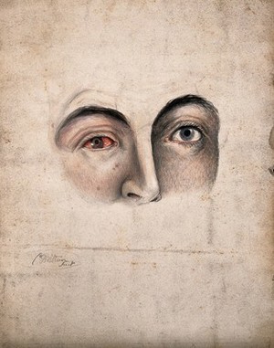 view A section of a face (eyes and nose) with a disease affecting one eye. Watercolour by Christopher D' Alton.