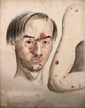 Head of a man with a severe disease affecting his face; and a section of diseased arm. Watercolour by Christopher D' Alton.