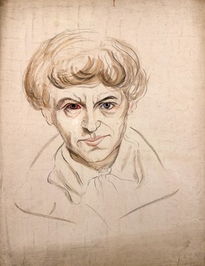 view Head of a man with a disease affecting his eye. Watercolour by Christopher D' Alton, 1857.