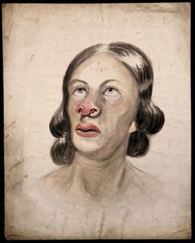 Head of a woman with a disease affecting her nose. Watercolour by Christopher D' Alton (?).