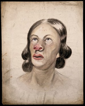 view Head of a woman with a disease affecting her nose. Watercolour by Christopher D' Alton (?).