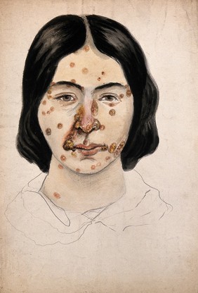 Head of a woman with a severe disease affecting her face. Watercolour by Christopher D' Alton (?).