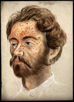 Head of a man with a severe disease affecting his face. Watercolour by Christopher D' Alton.