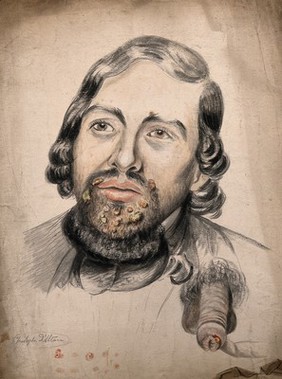 Head of a man with a disease affecting his face (around the mouth and chin); a diseased penis, and a group of sores in detail. Watercolour by Christopher D' Alton, 1858.