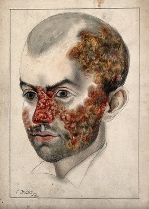 view Head of a man with a severe disease affecting his face and scalp. Watercolour by Christopher D' Alton, 1872.