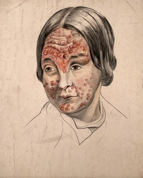 Head of a woman with a severe disease affecting her face. Watercolour by Christopher D' Alton, 1858.