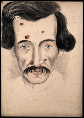 Head of a man with a disease affecting his face. Watercolour by Christopher D' Alton.