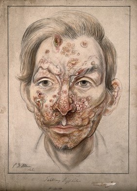 Head of a man with a syphilitic lesions affecting his face. Watercolour by Christopher D' Alton, 1874.