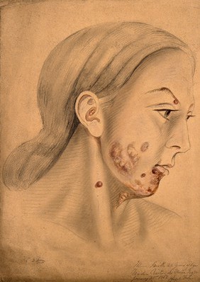 Head of a woman with a disease affecting her face (seen in profile). Watercolour by Christopher D' Alton, 1867.