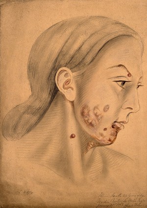 view Head of a woman with a disease affecting her face (seen in profile). Watercolour by Christopher D' Alton, 1867.
