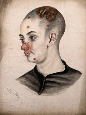 Head of a young woman with a severe disease affecting her face and scalp. Watercolour by Christopher D' Alton, 1858.