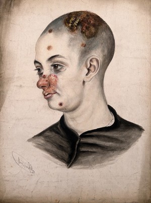 view Head of a young woman with a severe disease affecting her face and scalp. Watercolour by Christopher D' Alton, 1858.