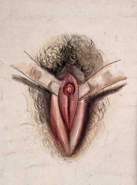 Female genitalia held open by two fingers to show an area of diseased tissue. Watercolour by Christopher D' Alton, 1857.