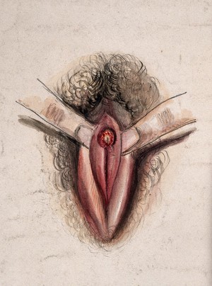view Female genitalia held open by two fingers to show an area of diseased tissue. Watercolour by Christopher D' Alton, 1857.