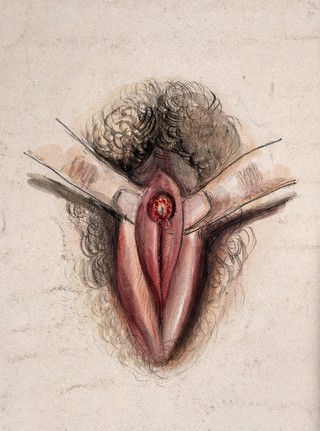 Female genitalia held open by two fingers to show an area of diseased tissue. Watercolour by Christopher D' Alton, 1857.