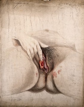 Female genitalia held open by the hand to show diseased tissue, with clusters of sores at the top of the thighs to each side. Watercolour by Christopher D' Alton, 1857.