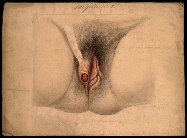 Female genitalia held open by a finger to show an area of diseased tissue. Watercolour by Christopher D' Alton, 1866.