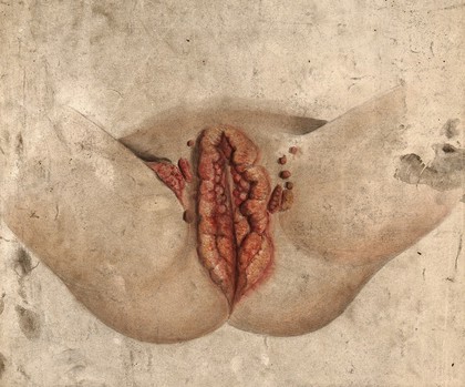 Female genitalia showing severely diseased tissue, and sores on the upper thighs to each side. Watercolour by Christopher D' Alton, 1857.