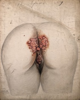 The diseased tissue around the anus and genitals of a woman, as seen from behind. Watercolour by Christopher D' Alton, 1857.