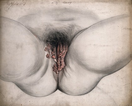 Female genitalia showing severely diseased tissue. Watercolour by Christopher D' Alton.