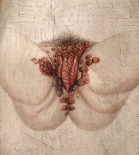 Female genitalia showing severely diseased tissue spreading on to the thighs and anus. Watercolour by Christopher D' Alton, 1857.