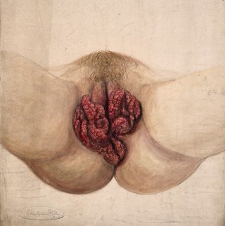 Female genitalia showing severely diseased tissue. Watercolour by Christopher D' Alton.