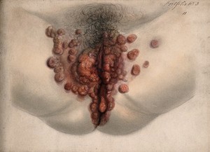 view Female genitalia showing severely diseased tissue. Watercolour by Christopher D' Alton, 1865.