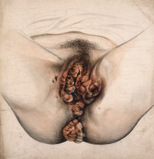 view Female genitalia showing severely diseased tissue from the pubis to the anus. Watercolour by Christopher D' Alton, 1855.