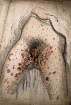 The lower half of a woman (seen from the waist down with her hand lifting up her garment) with her legs apart to show severely diseased genitals and sores all over the exposed parts of her body. Watercolour by Christopher D' Alton, 1858.