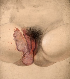 view Female genitalia showing severely diseased tissue spreading on to the right inside thigh. Watercolour by Christopher D' Alton, 1865.