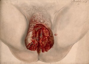 view Female genitalia showing severely diseased tissue. Watercolour by Christopher D' Alton, 1867.