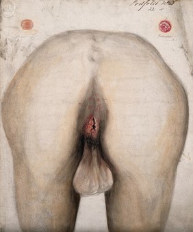 The diseased anus of a man as seen from behind; two details of sores on other parts of the body. Watercolour by Christopher D' Alton, 1857.