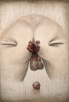 The diseased anus and scrotum of a man, as seen from behind, with two fingers on the buttocks to hold them apart; and a detail of a diseased penis. Watercolour by Christopher D' Alton, 1858.