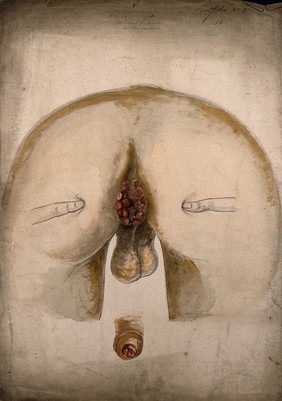 The diseased anus of a man, as seen from behind, with two fingers on each buttock to hold them apart; and a detail of a diseased penis. Watercolour by Christopher D' Alton.