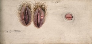 view Sores on the female genitalia: three details. Watercolour by Christopher D' Alton, 1836.