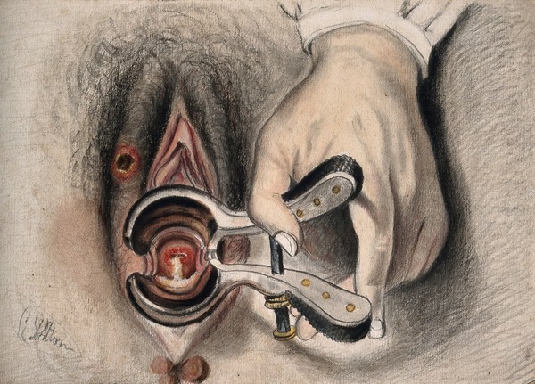 An infected sore on the female genitalia shown with the aid of a vaginal speculum. Watercolour by C.D' Alton, 18--.