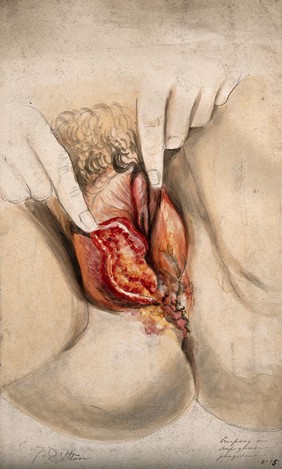 Female genitalia held open by two fingers to show an area of diseased tissue. Watercolour by C. D'Alton, 18--.