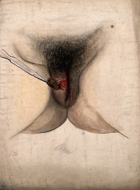 Female genitalia with an area of diseased tissue: a surgical instrument is shown extracting part of the diseased area. Watercolour by C. D' Alton, 1858.