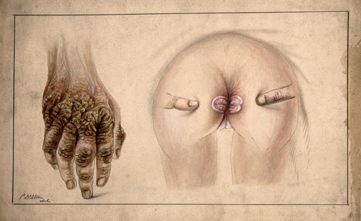 Lesion on anus of child alongside mother's hand, 1875