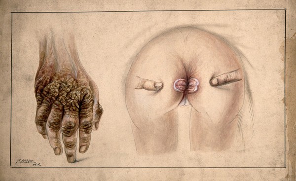 Area of diseased tissue around the anus of a four-year-old girl, with a detail showing the diseased hand of the child's mother (?) Watercolour by C. D'Alton, 1875.